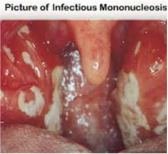 mononucleosis throat